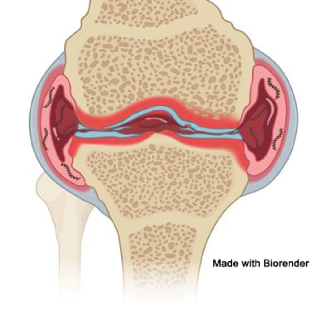 Inflamed Knee Joint